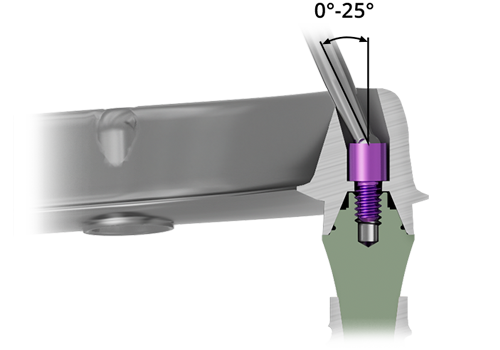 Angled Screw Channels (ASC)