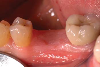 graft containment 3 with AlloDerm SELECT GBR