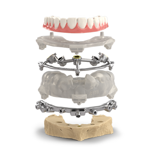 Stackable guides by Vulcan Custom Dental