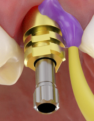 Open tray impression taking