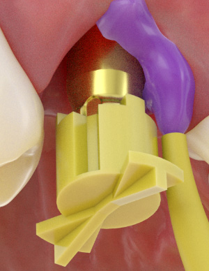 Closed tray impression taking