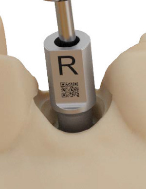 Digital or traditional impression taking using conical titanium scan bodies