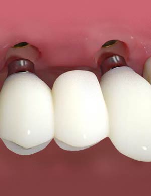 CAD/CAM Conical Titanium Base for bridges