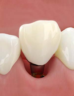 CAD/CAM Conical Titanium Base for crowns