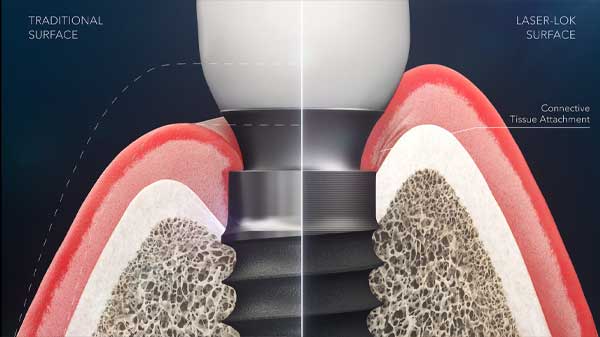 Introduction to Laser-Lok