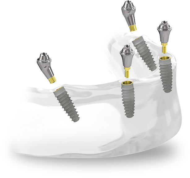 Full-arch with Tapered Pro Conical dental implants