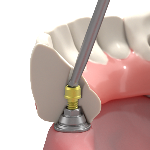 Direct to Multi-unit screw