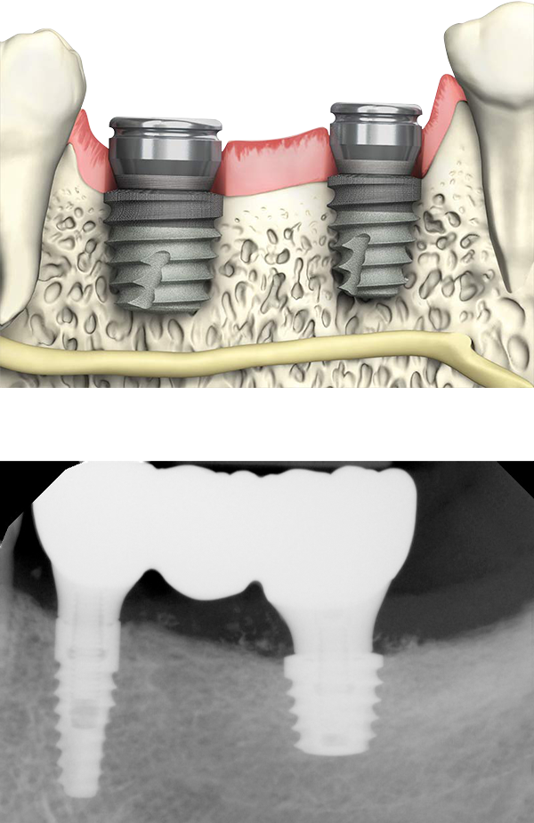 Tapered Short dental implant