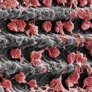 Laser-Lok microchannels