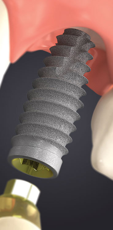 Tapered Pro dental implants