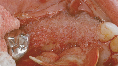 composite graft of Grafton DBM and FDBA