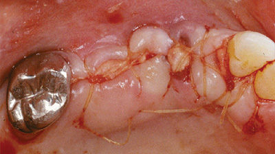 AlloDerm GBR used as barrier membrane