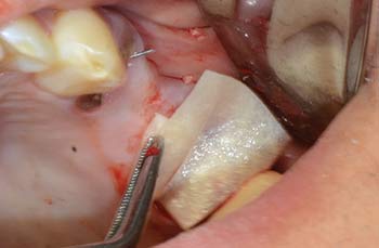 Mem-Lok Pericardium case image 2