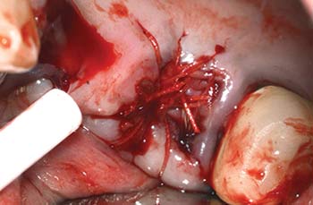 Mem-Lok Pericardium case image 4