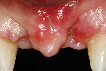 MinerOss Cancellous defect