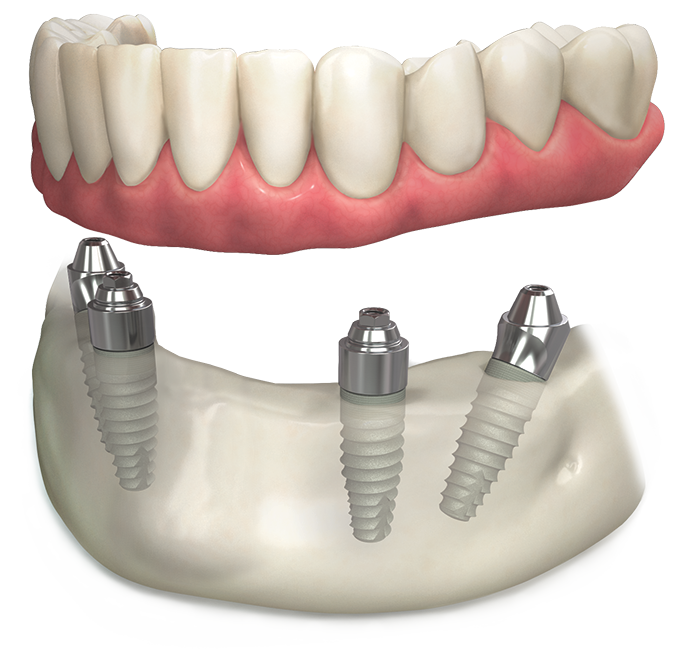 Multi-unit abutment system