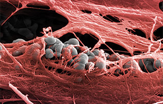 Laser-Lok with soft tissue