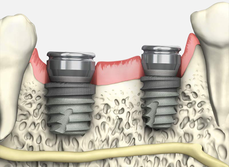 Tapered Short implants