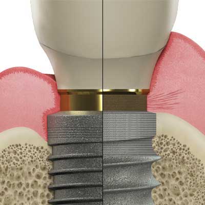 Laser-Lok vs standard implant