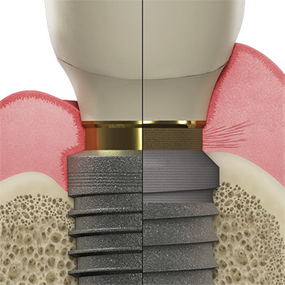 Laser-Lok vs standard implant